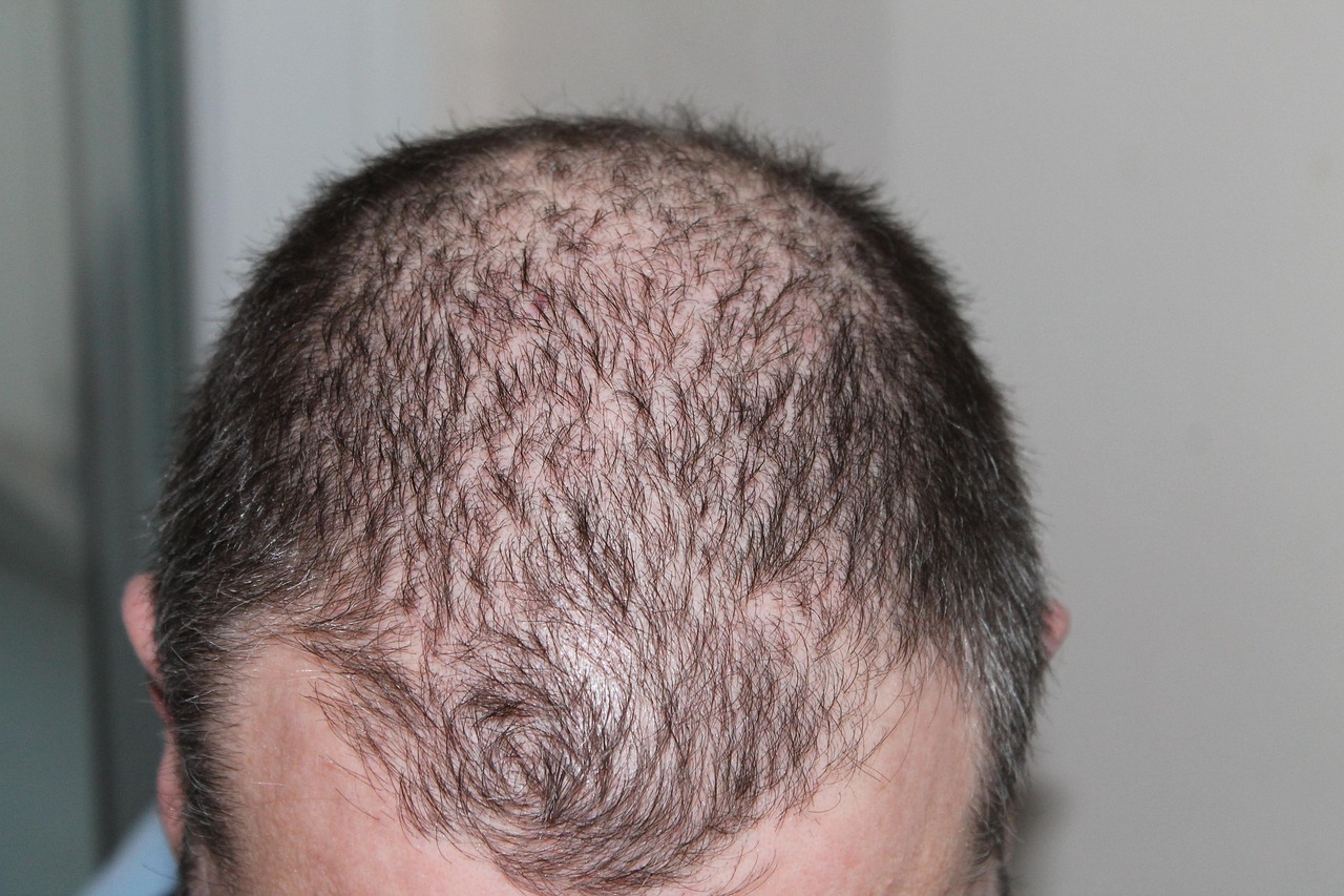 peptides and hair loss
